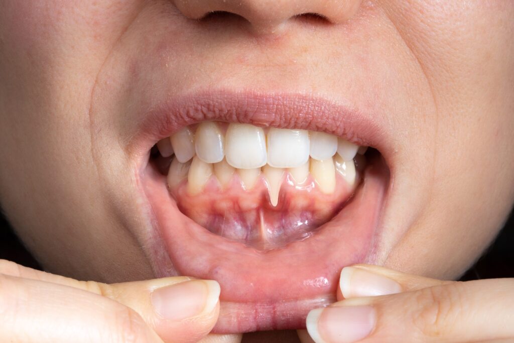 Preparing for teeth whitening with receding gums Blackpool